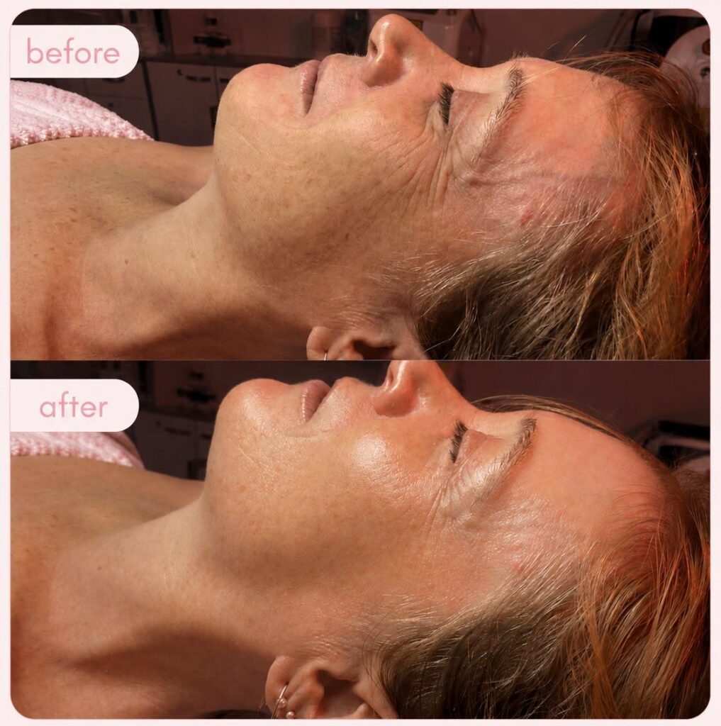 Express facial