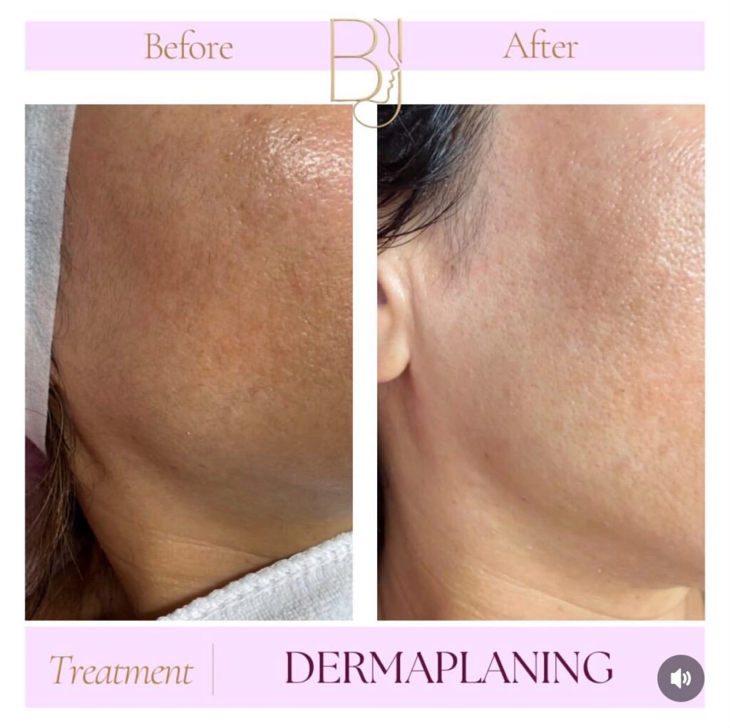 High frequency facial