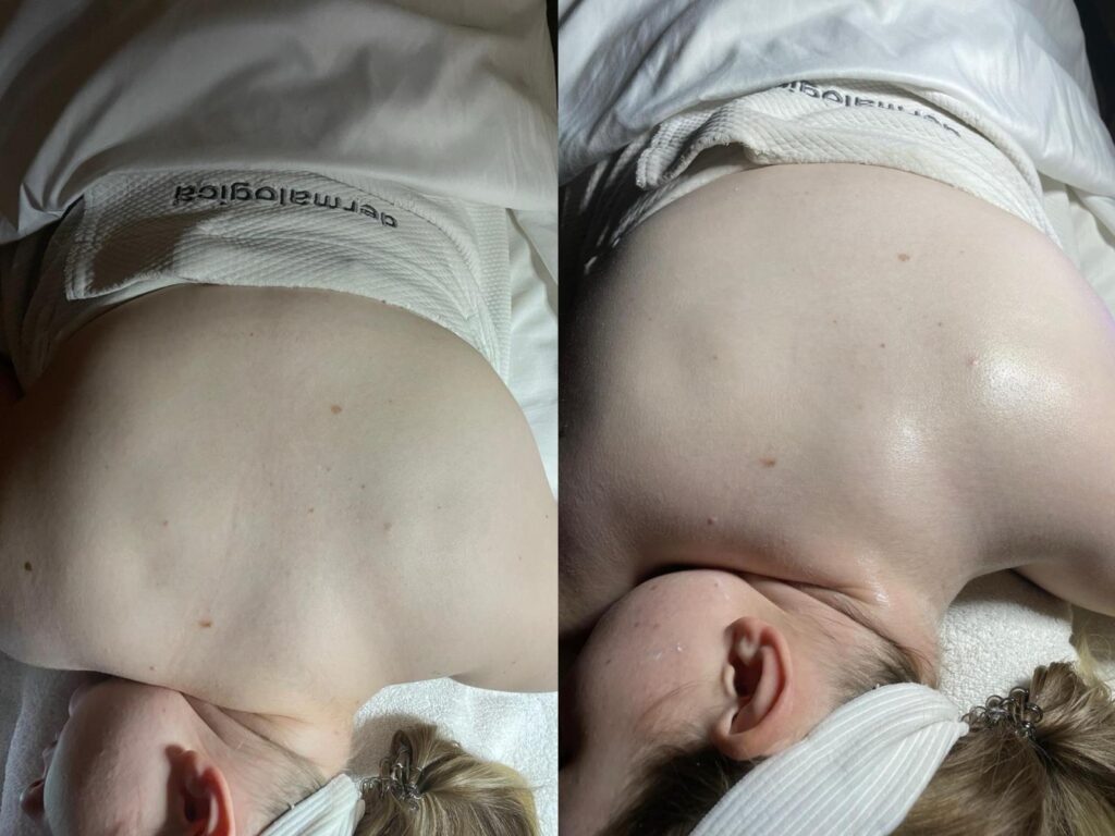 Back facial