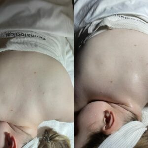 Back facial